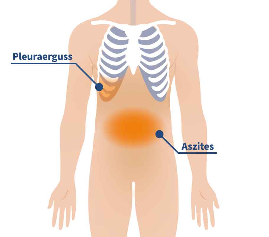 Wasser Im Bauch Und In Der Lunge